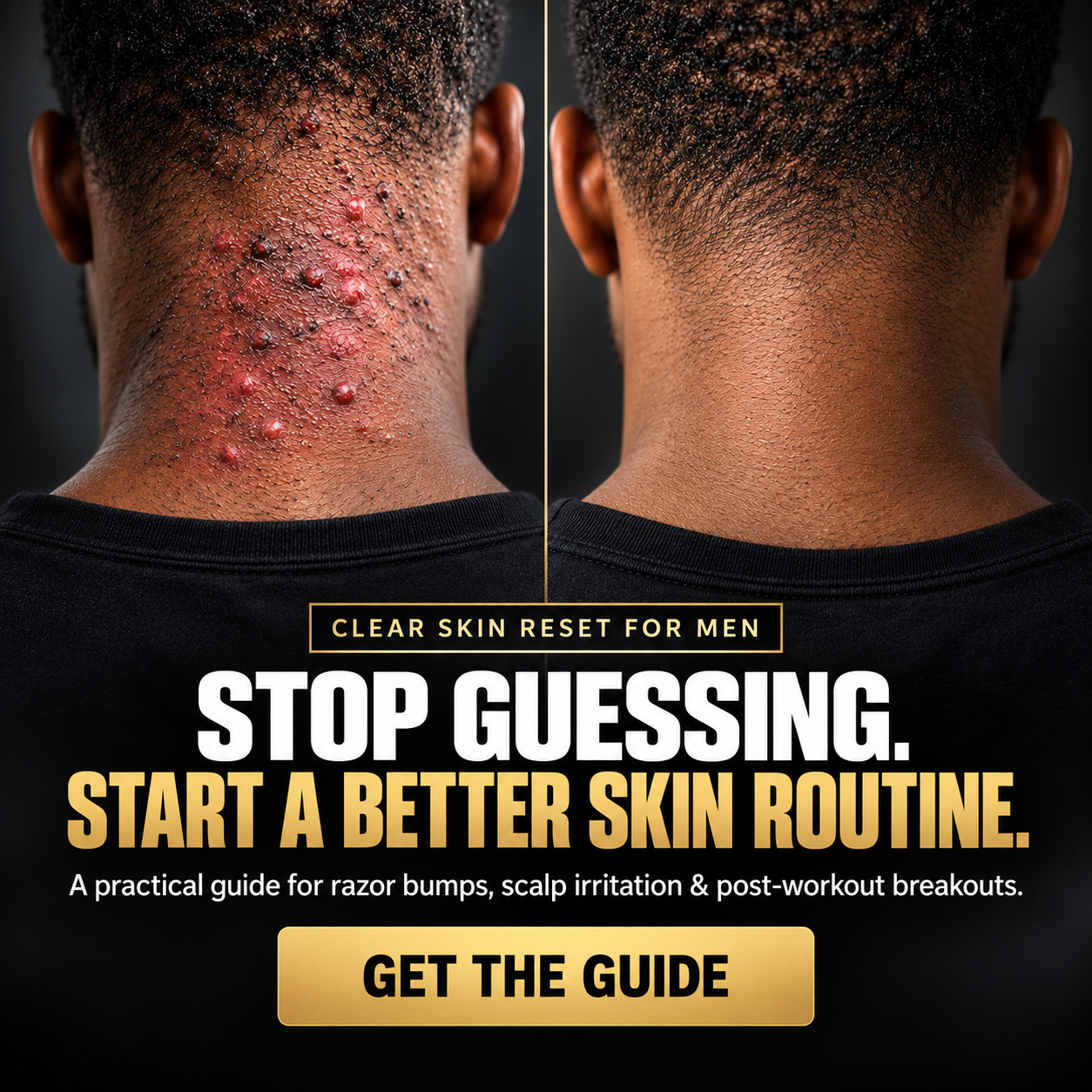 Back of a man's neck before and after: inflamed razor bumps and ingrown hairs on the left, calmer smoother skin on the right, above the words Stop guessing, start a better skin routine.